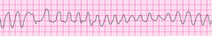 A patient has a witnessed loss of consciousness. The lead 2 ECG is shown. appropriate treatment?