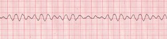 A patient remains in ventricular fibrillation despite 1 shock and 2 minutes of continuous CPR. The next intervention is to