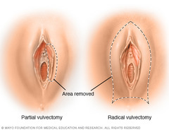 According to the text, vulvectomy codes are divided based on the _____ and the extent of the vulvar area removed during the procedure?