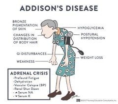 Addison's Disease Treatment: