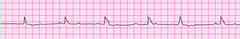 After verifying the absence of a pulse, you initiate CPR with adequate bag-mask ventilation. The patient's lead II ECG appears below. What is your next action?