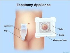 Caution with a patient that has an ileostomy