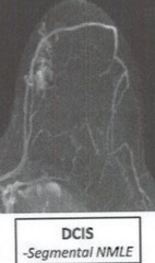 Classic look for breast lesion on MRI: what is it?
- Clumped, ductal, linear or segmental NMLE