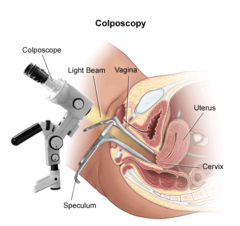 Colposcopy of the cervix with a biopsy.