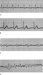 Determine which of the following electrocardiogram (ECG) tracings is missing P waves but is otherwise regular.

 A 
 B 
 C 
 D