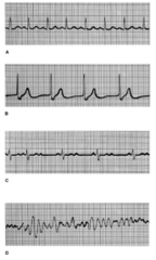 Determine which of the following electrocardiogram (ECG) tracings is missing P waves but is otherwise regular.

ECG tracings showing normal and various abnormal rhythms.
A 
B 
C 
D