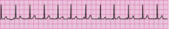 During a pause in CPR, you see this lead II ECG rhythm on the monitor. The patient has no pulse. What is the next action?