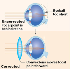Farsightedness is more properly called ________.
Select one:
a. myopia
b. hyperopia 
c. hypopia
d. presbyopia