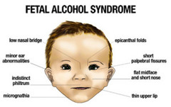 fetal alcohol syndrome