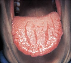 Fissure tongue