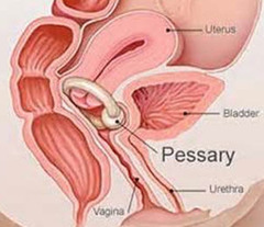 Fitting and Insertion of a Pessary.