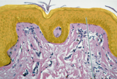 Highlighted epithelium is stratified squamous epithelium, keratinized.