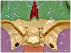 Identify the region of the sphenoid bone in contact with the pituitary gland.