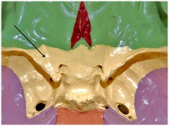 Identify the region of the sphenoid bone that contains the optic canal.