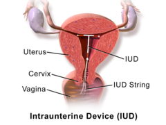 In which of the following categories would you locate a code for removal of an IUD?