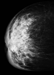 Inflammatory breast cancer:
- how does it present?
- mammo buzzword
- treatment?
- prognosis?