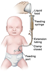 Intermittent tube feeding formula set rate: