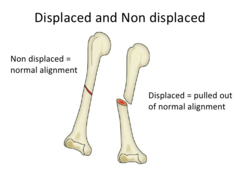 Is a displaced fracture anatomically aligned?