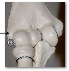 Lateral epicondyle