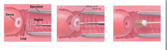 Loop electrode excision procedures are also refereed to as?