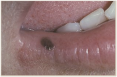 Oral Macule
