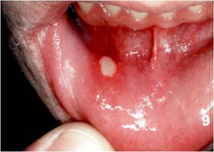 Oral Ulcer