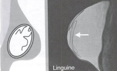 Overview Intracapsular Rupture:
- what is the capsule?
- solitary?
- classic sign