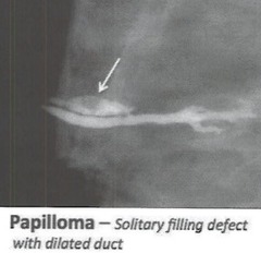 Papilloma:
- age?
- location?
how does it look on mammo, US, galactography?