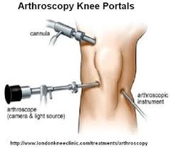 Post operative tx of arthroscopy
