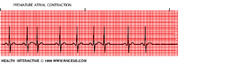Premature atrial contractions (PAC's)