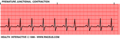 Premature junctional contractions (PJC)