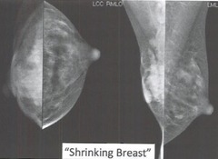 shrinking breast = ____
- why does it have this appearance?