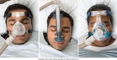 sleep apnea