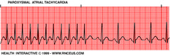 Supraventricular Tachycardia (SVT)
 aka
Paroxysmal atrial tachycardia (PAT)
