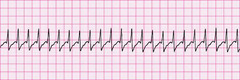 SVT - Subventricular Tachycardia