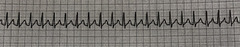 Syncronized cardioversion.