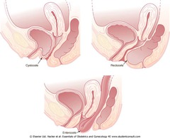 This term describes an incision of the vagina to gain access to the peritoneal cul-de-sac to explore of to drain abscess?