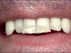 Tooth Erosion