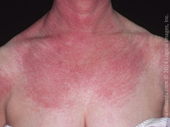 Upper chest petechiae after a long bone fracture