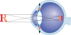 What condition results when distant objects focus in front of the retina, rather than on it?
