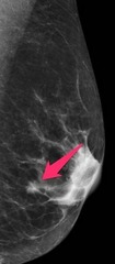 what does tubular IDC look like on imaging?
- association on imaging?

- contralateral breast in tubular ca has __% risk of also having cancer