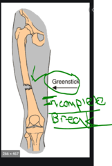 What kind of fracture is an INCOMPLETE break?