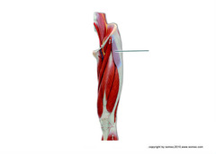 Which muscle is highlighted?
A. iliopsoas
B. tensor fasciae latae
C. rectus femoris
D. vastus lateralis